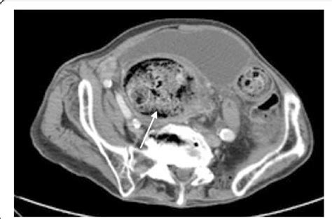 Axial IV contrast-enhanced <b>CT</b> image reveals <b>large</b> heterogeneous mass in pelvis, in expected location of cervix, that encased sigmoid <b>colon</b> on contiguous slices. . Large amount of stool in colon on ct scan